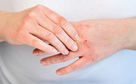乳膠手套能否有效防止長(zhǎng)水泡？